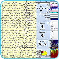 Многоканальный ЭЭГ-мониторинг церебральных функций