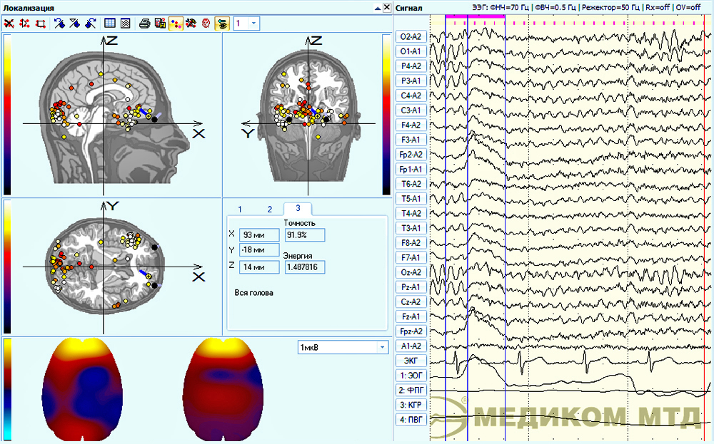 An example of EEG fragment localization without the electrooculgoram influence taken into account